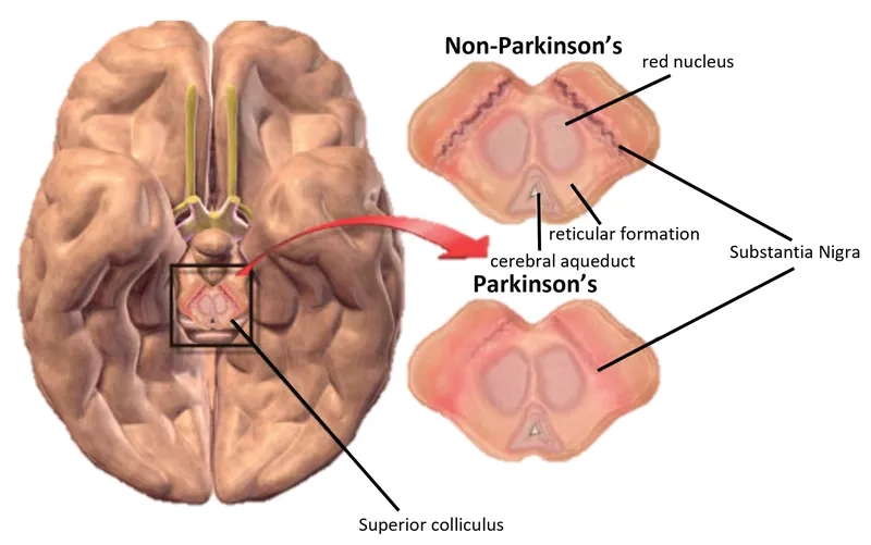 A visual guide to Parkinson's disease symptoms