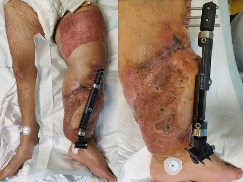 Microscopic view of an Acinetobacter infection