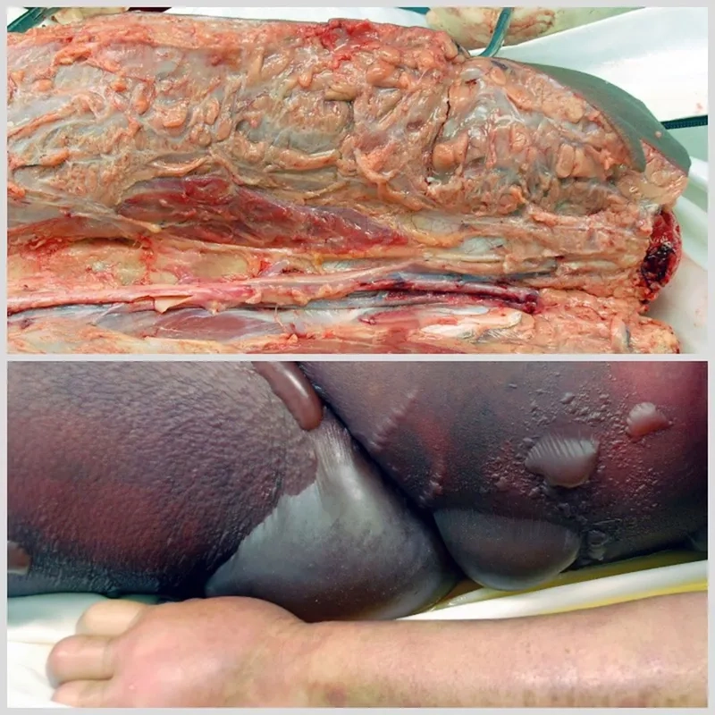 Hospital isolation room for Acinetobacter baumannii