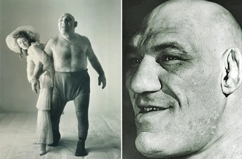 Understanding what is acromegaly and its causes