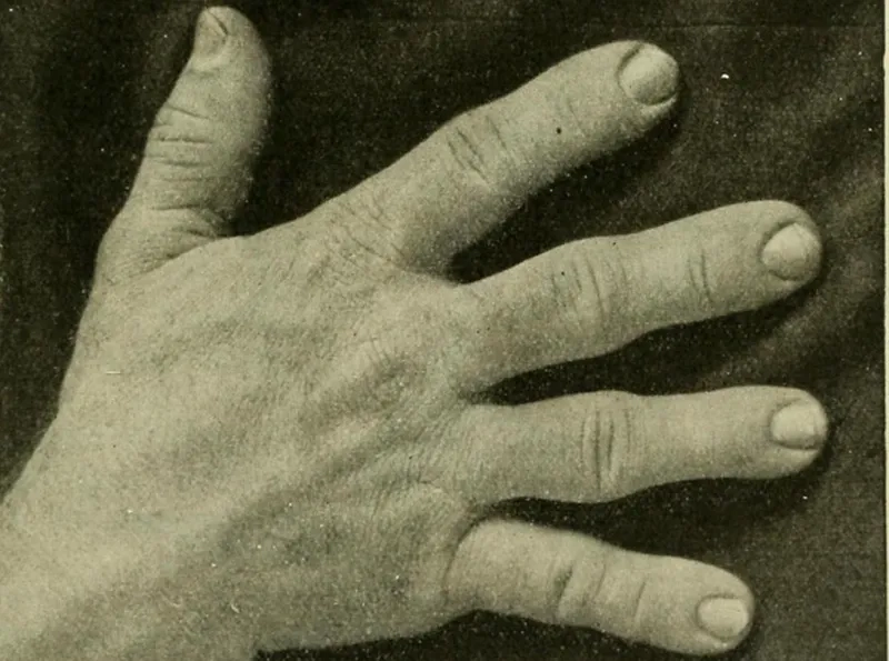 Detecting pituitary tumor linked to acromegaly