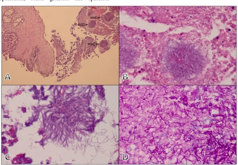 The dangers of Acinetobacter infection explained