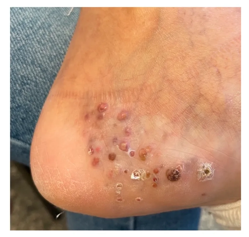 Isolation protocols for Acinetobacter baumannii patients