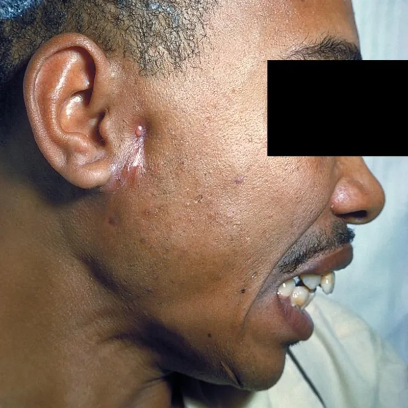 An overview of Acinetobacter baumannii infection