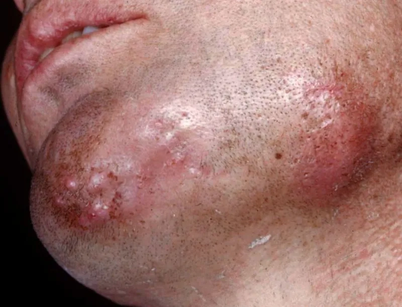 A close-up view of an Acinetobacter infection