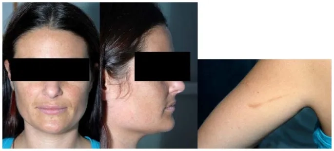 Prescription bottle of hydrocortisone tablets