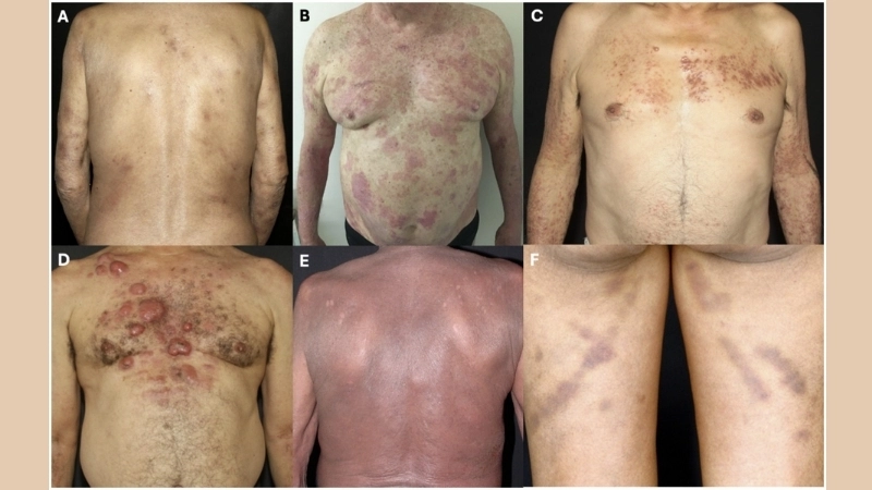 Adult T-cell Leukemia/Lymphoma divided into ATL subtypes