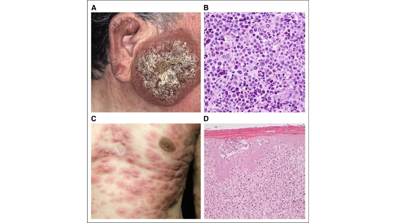 Adult T-cell Leukemia/Lymphoma linked to HTLV-1 infection