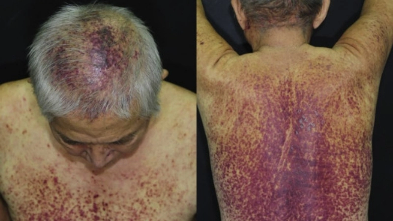 Adult T-cell Leukemia/Lymphoma differs from cutaneous T-cell lymphoma