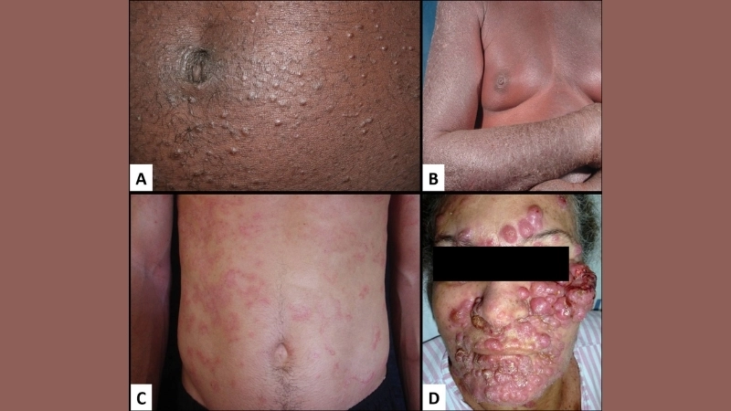 Adult T-cell Leukemia/Lymphoma classified as leukemia lymphoma