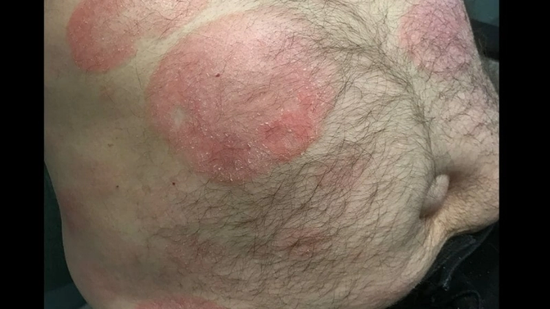 Adult T-cell Leukemia/Lymphoma is a rare T-cell malignancy