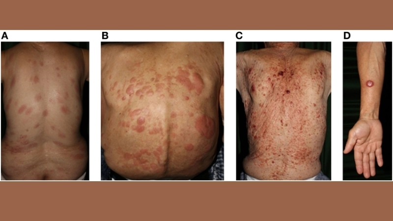 Adult T-cell Leukemia/Lymphoma among HTLV-1 associated diseases