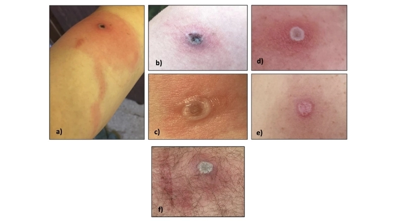 Alaskapox symptoms show mild fever and rash