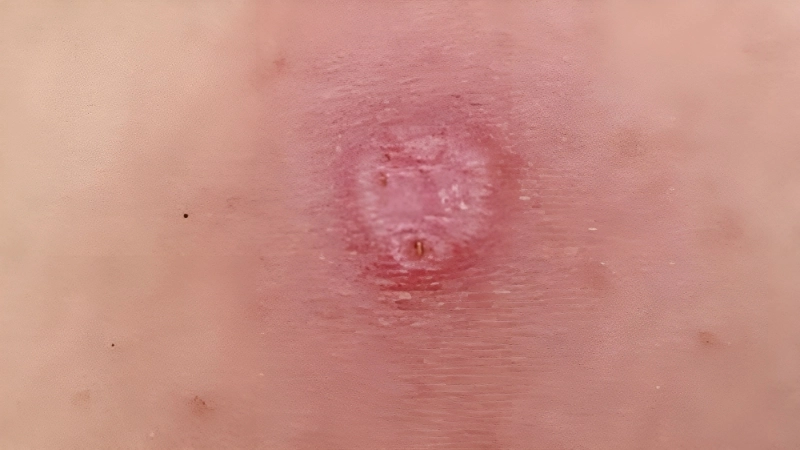 Alaskapox treatment options still under study