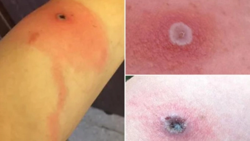 Alaskapox fatality rare but risk remains