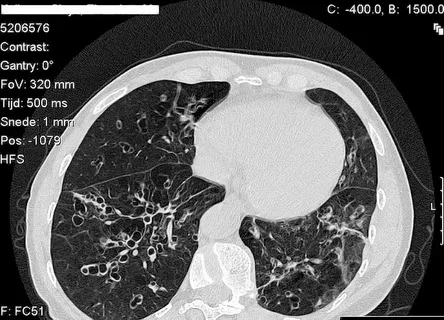 Chronic sinusitis - When your sinus infection never leaves