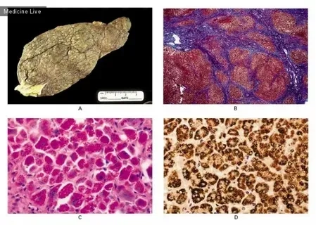 What is alpha-1 explained in genetic disorder infographic