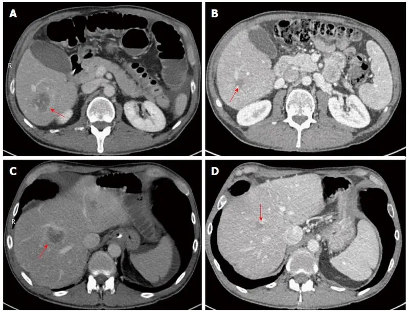 Alpha-1 testing process in laboratory diagnostic setting