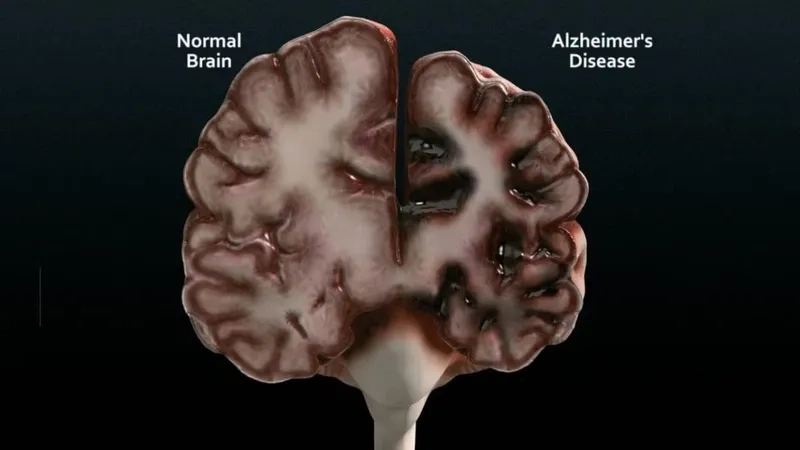 The buildup of plaques, a cause of Alzheimer's