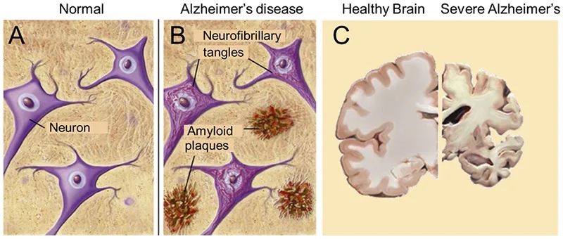 A doctor discussing Alzheimer's treatment
