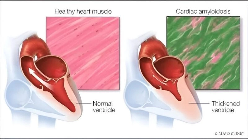 Cardiac amyloidosis symptoms warning signs in the heart