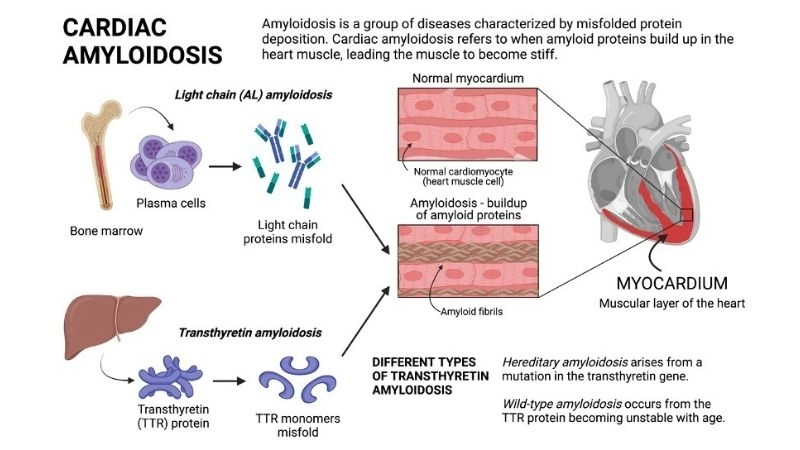 Transthyretin amyloidosis protein related heart condition