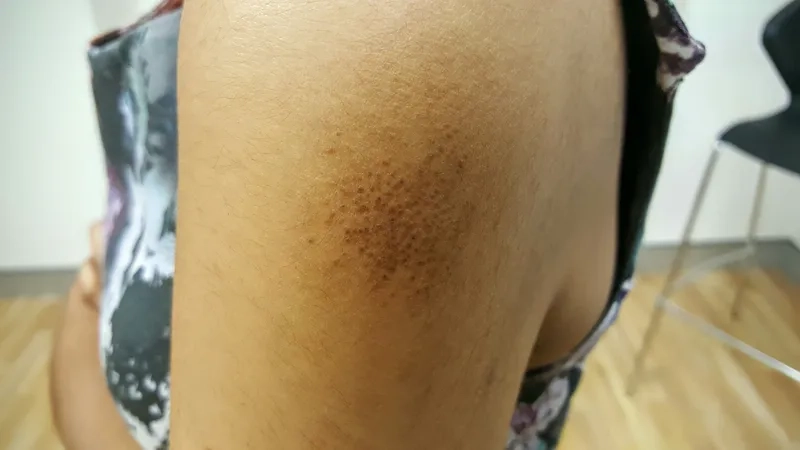 Illustration of transthyretin amyloidosis ATTR