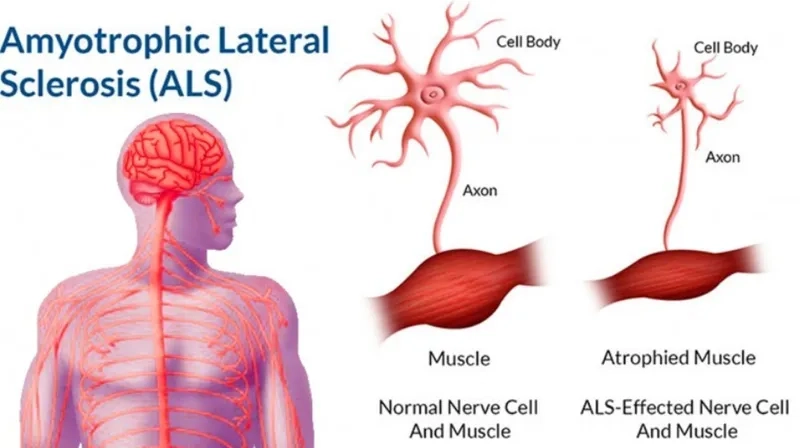 A medical illustration explaining what is ALS