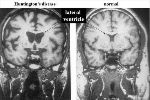 An infographic explaining what is huntington's disease