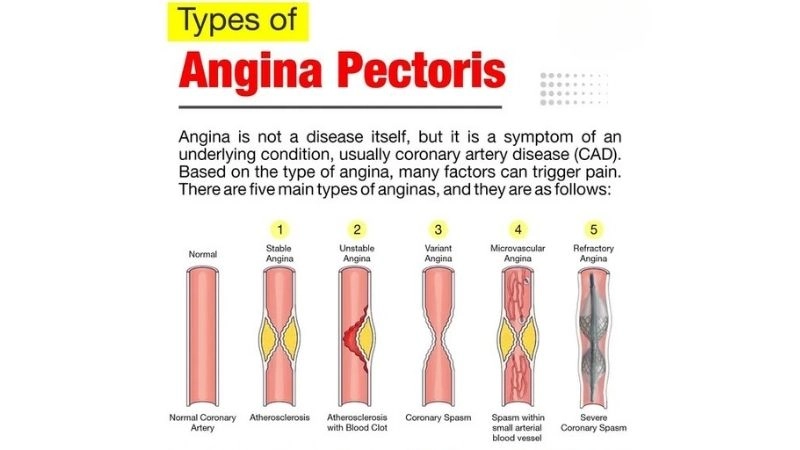 Silent chest pain signs of angina pectoris