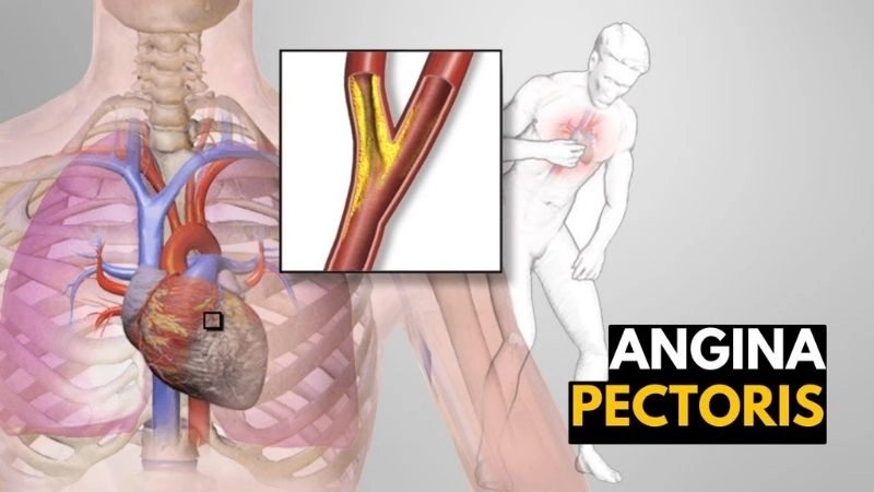Simple angina pectoris meaning in Hindi