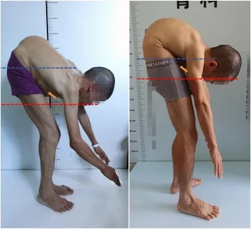 An X-ray showing the characteristic bamboo spine