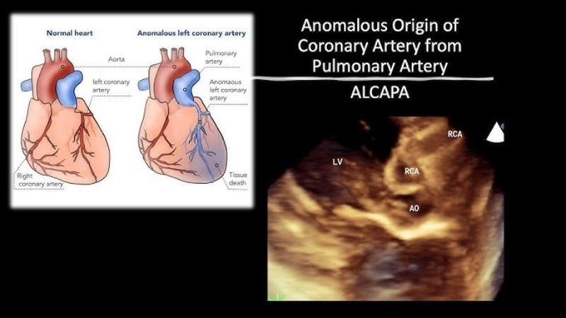 Anomalous left coronary artery symptoms warning cardiac signs