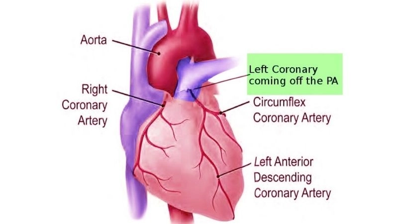 ALCAPA surgery lifesaving correction for coronary artery defect