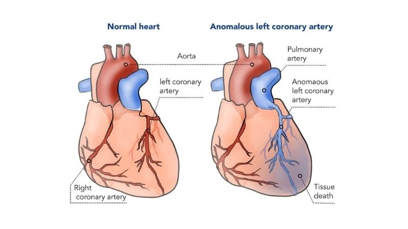 Anomalous origin of left coronary artery rare congenital anomaly