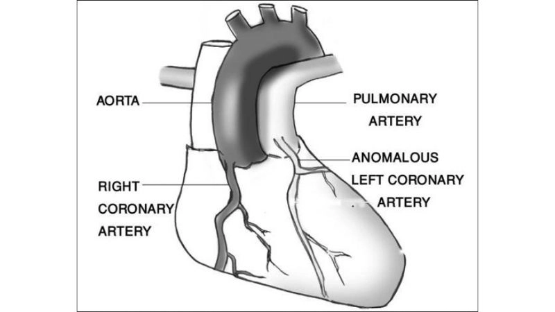 Bland-White-Garland syndrome another name for ALCAPA condition