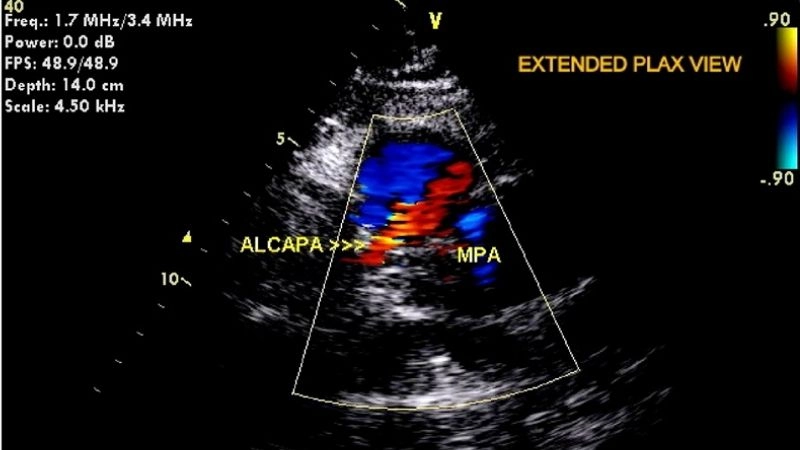 Coronary artery steal phenomenon abnormal blood flow mechanism