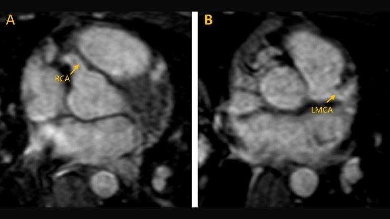 Anomalous left coronary artery in infants critical early signs