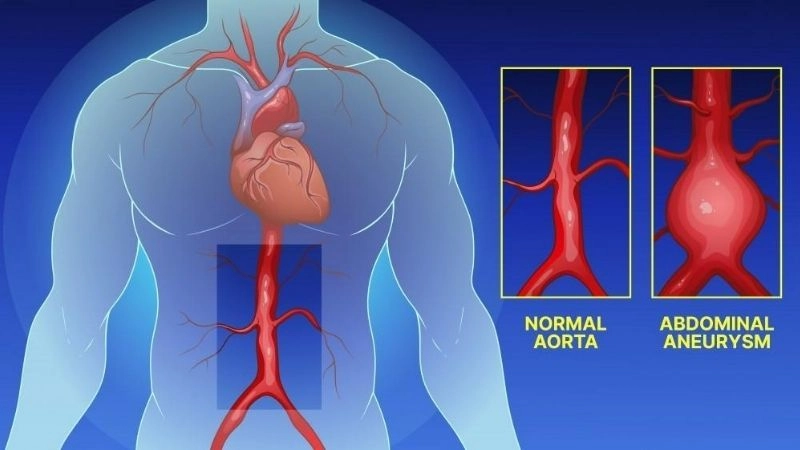 Thoracic aortic aneurysm and its hidden dangers