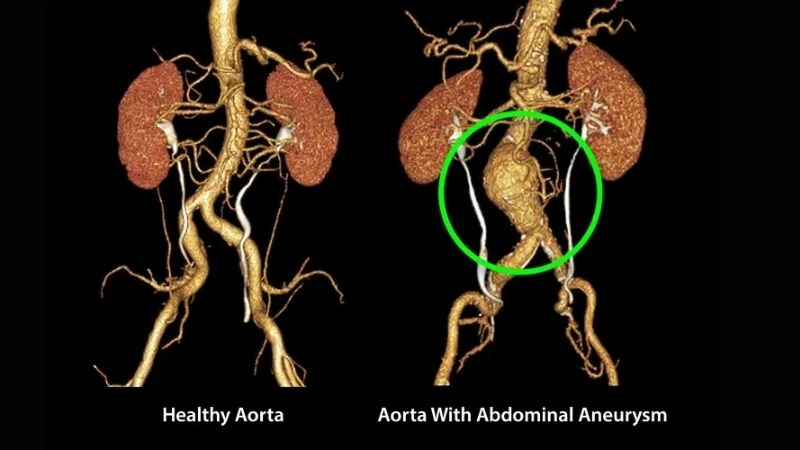Abdominal aortic aneurysm posing silent threats