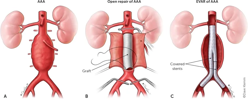 Surgeon performing an aortic aneurysm repair