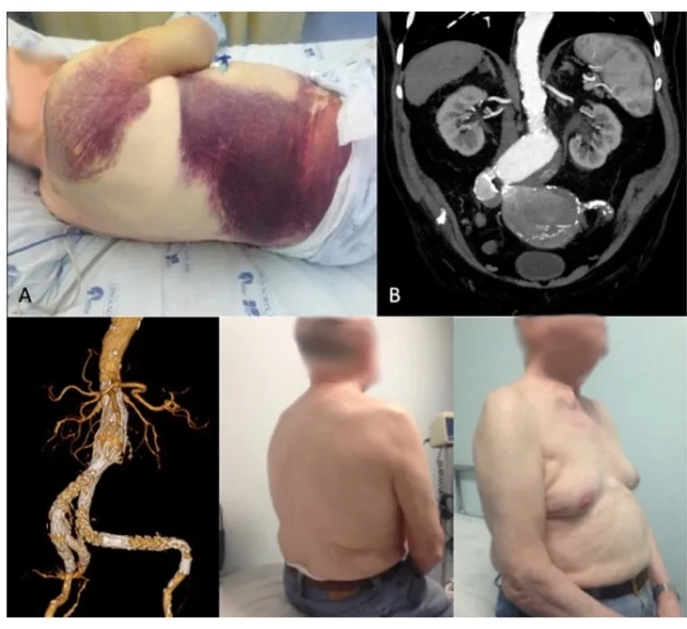 Aortic aneurysm size chart for surgery reference