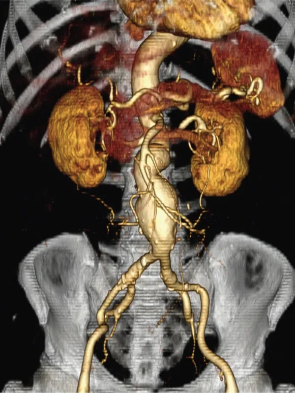 Anatomical view of an abdominal aortic aneurysm (AAA)