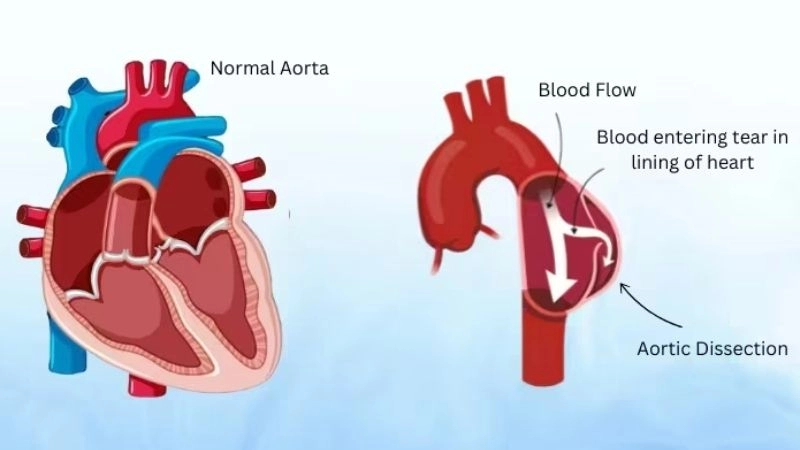 Aortic dissection and Marfan syndrome strong link