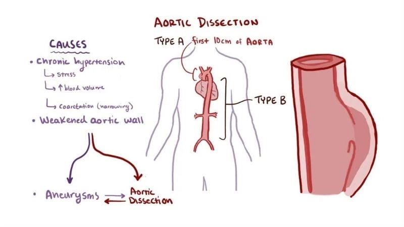 Aortic dissection survival rate and prognosis data