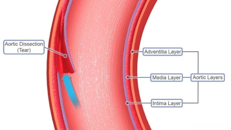 Aortic dissection surgery as a life saving option