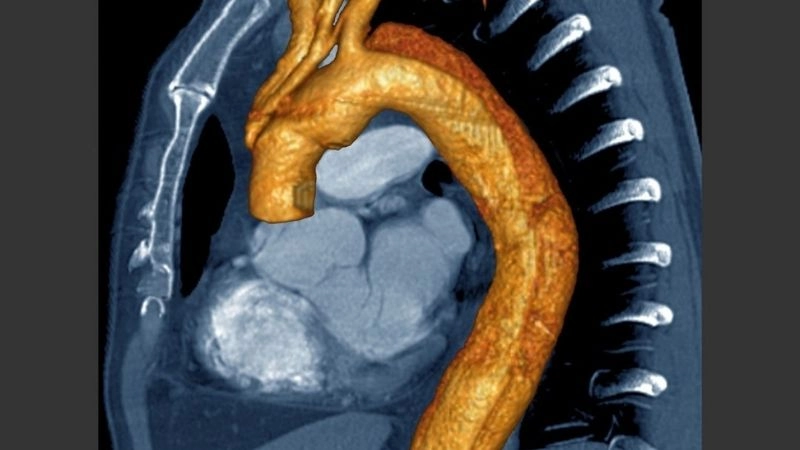 Aortic dissection risk factors everyone should know