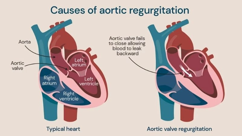 Aortic Regurgitation Treatment helps reduce heart strain