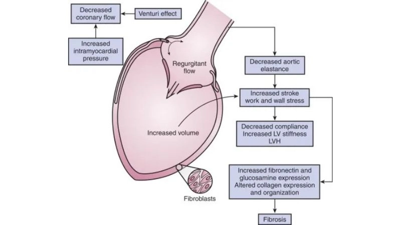 Aortic Regurgitation Grades classify leak severity