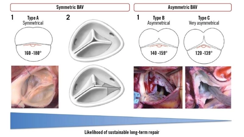 Aortic Regurgitation Vs Stenosis shows clear difference